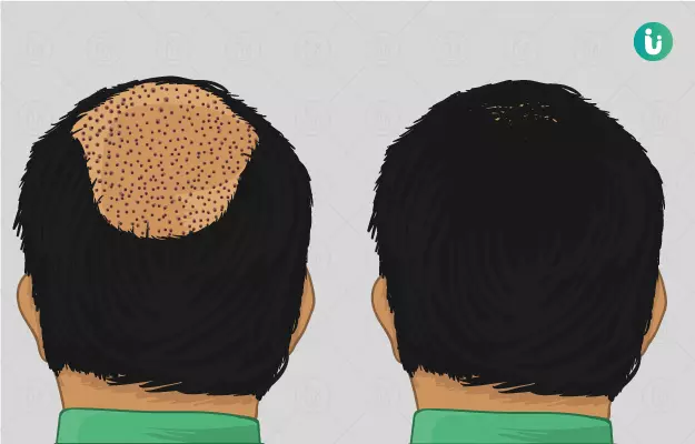 हेयर ट्रांसप्लांट - Hair transplant in hindi