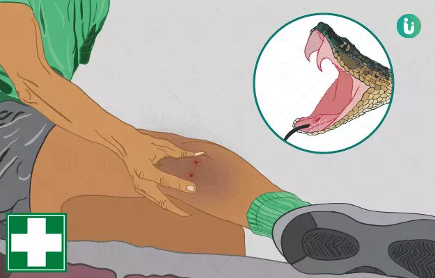 सांप के काटने पर क्या करना चाहिए - Snake bite first aid in Hindi