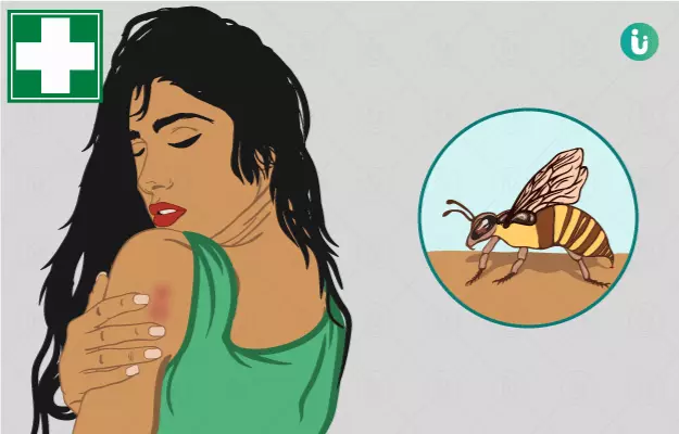 What to do if you get a bee sting