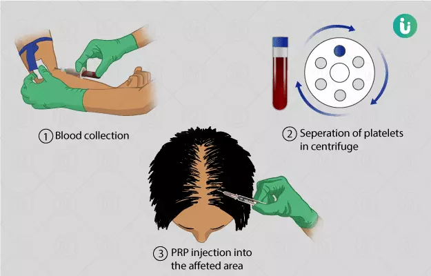 PRP therapy for hair loss