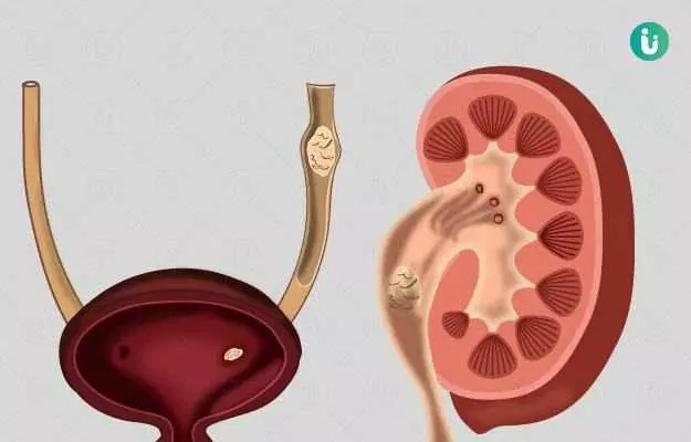 पथरी (किडनी स्टोन) में क्या खाना चाहिए, क्या नहीं और परहेज - What to eat and what not to eat in kidney stone in Hindi