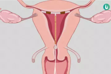 Intrauterine Device (IUD): Long-Term Contraception