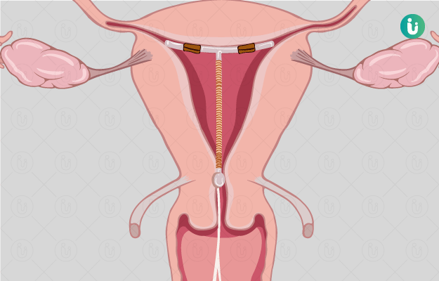 iud-kya-hai-types-fayde-nuksan