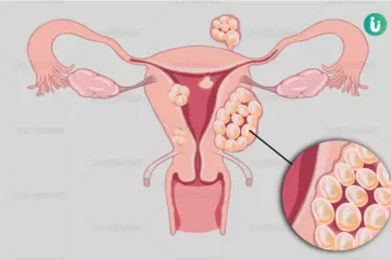 What Are Uterine Fibroids? Signs and Symptoms to Watch For