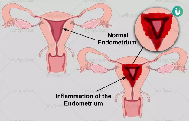 बच्चेदानी (गर्भाशय) में सूजन - Endometritis in Hindi