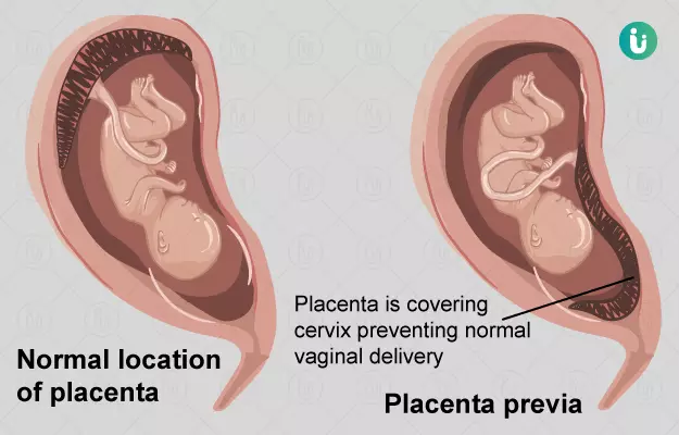 प्लेसेंटा प्रिविआ क्या है, क्यों होता है और उपचार कैसे किया जाता है - Placenta Previa in hindi