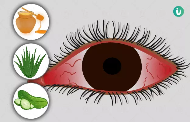 आंखों में जलन के घरेलू उपाय - Home remedies for burning eyes in Hindi