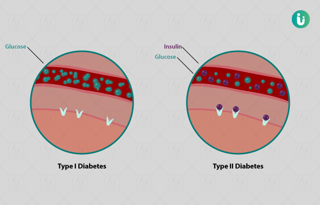 Type 1 Diabetes Symptoms Causes Risk Factor Diagnosis