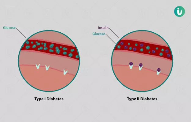 टाइप 1 मधुमेह - Type 1 Diabetes in Hindi