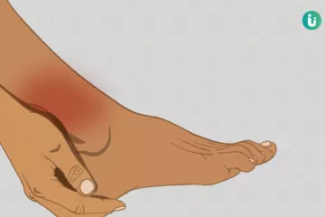 Understanding Sprained Ankles: Causes, Symptoms, and Treatment