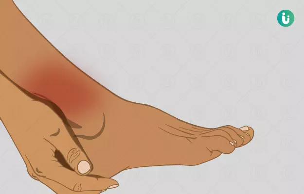 पैर में मोच - Sprained Ankle in Hindi