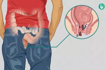 How to Manage and Treat Bleeding Piles: A Comprehensive Guide