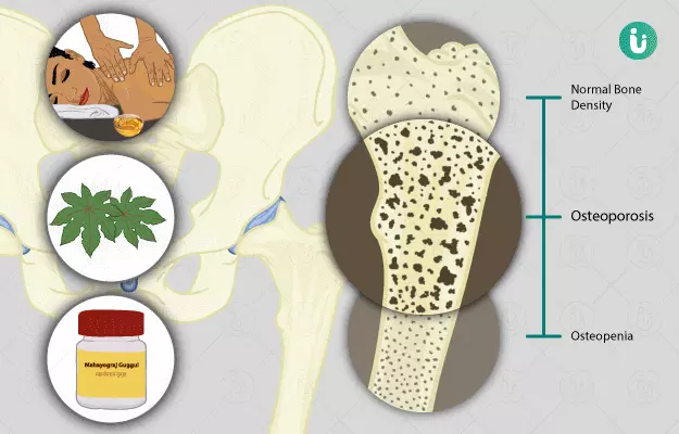 Ayurvedic medicine, treatment and remedies for Osteoporosis