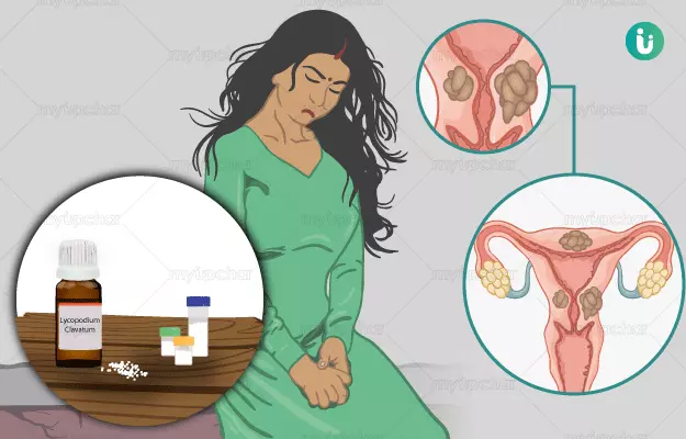 अंडाशय में सिस्ट की होम्योपैथिक दवा और इलाज - Homeopathic medicine and treatment for Ovarian Cysts in Hindi