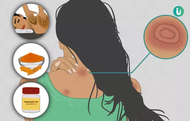 Ayurvedic medicine, treatment and remedies for Ringworm