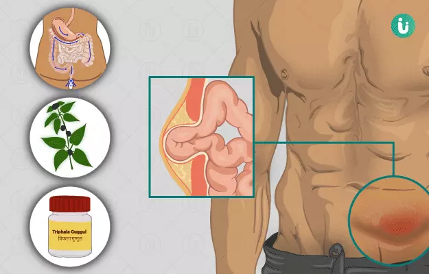 Ayurvedic medicine, treatment and remedies for Hernia