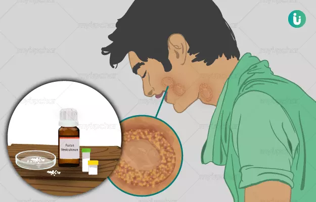 Homeopathic medicine, treatment and remedies for Fungal Infections
