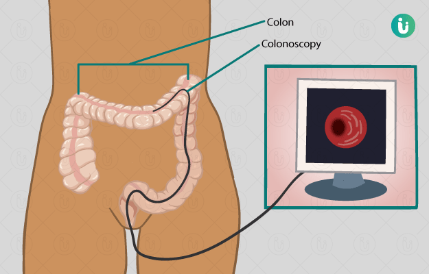 Colonoscopy Procedure Purpose Results Cost Price Online booking