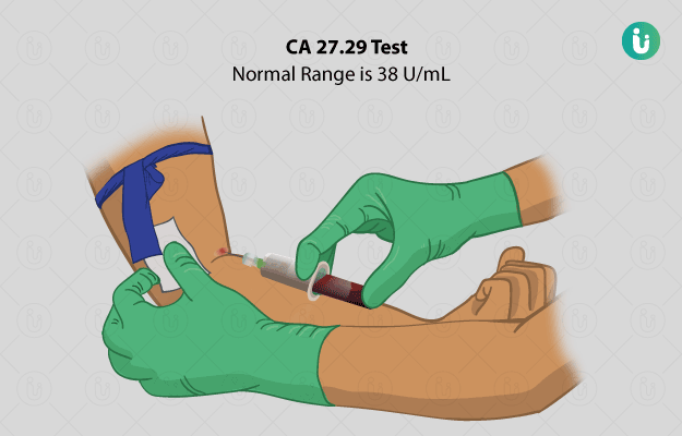 CA 27.29 Test: Procedure, Purpose, Results, Normal range, Cost