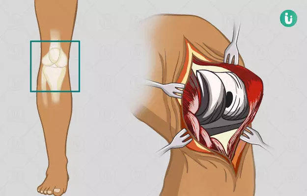 घुटने बदलने का ऑपरेशन या नी रिप्लेसमेंट सर्जरी - Knee Replacement Surgery (Knee Arthroplasty) in Hindi