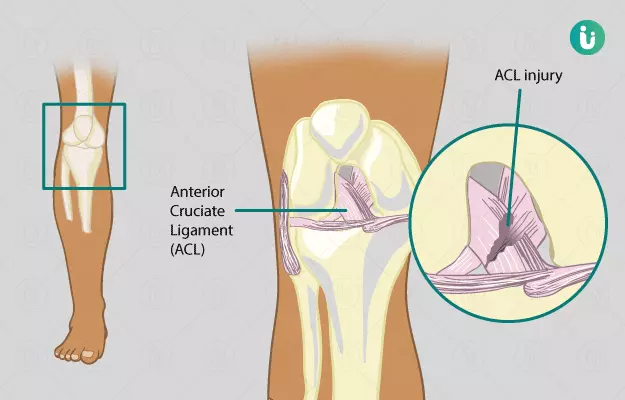 Anterior Cruciate Ligament (ACL) Reconstruction Surgery