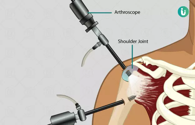 आर्थोस्कोपी कंधे की सर्जरी - Shoulder Arthroscopy in Hindi