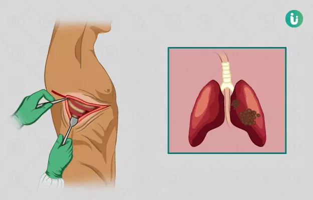 फेफड़ों के कैंसर का ऑपरेशन - Lung Cancer Surgery in Hindi