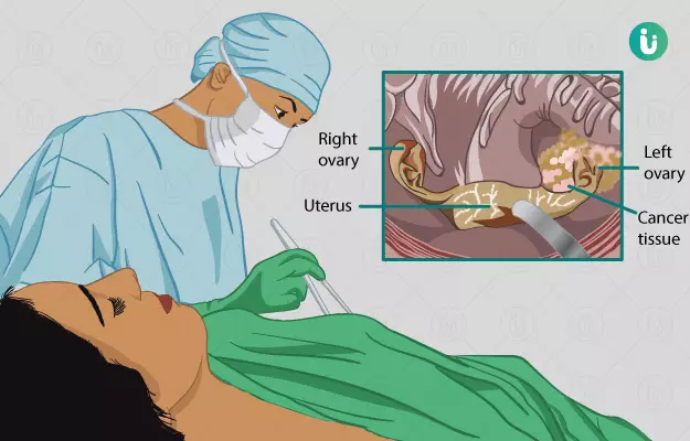 अंडाशय के कैंसर का ऑपरेशन - Ovarian Cancer Surgery in Hindi