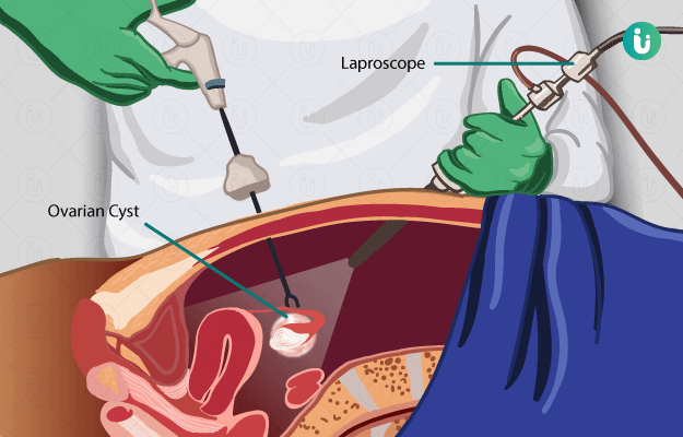 laparoscopic cyst removal