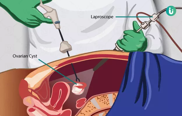 ओवेरियन सिस्ट सर्जरी - Ovarian Cyst Removal Surgery in Hindi