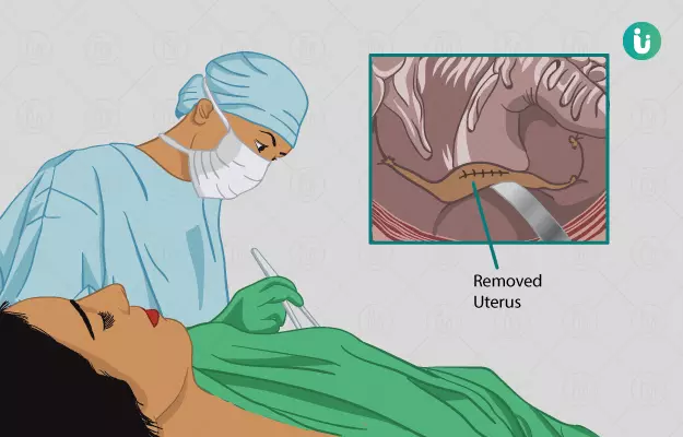 गर्भाशय हटाने का ऑपरेशन (हिस्टेरेक्टॉमी) - Hysterectomy in Hindi