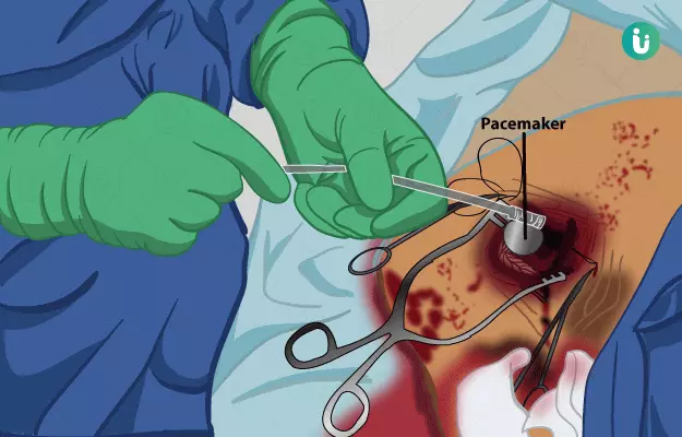 पेसमेकर सर्जरी - Pacemaker Surgery in Hindi
