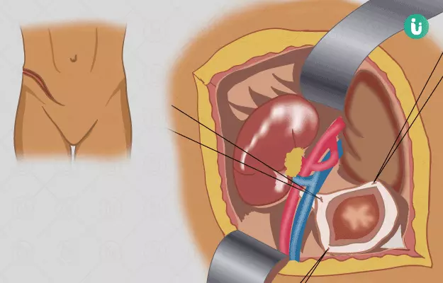 किडनी ट्रांसप्लांट - Kidney Transplant Surgery in Hindi