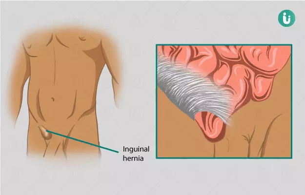वंक्षण हर्निया ऑपरेशन - Inguinal Hernia Surgery in Hindi