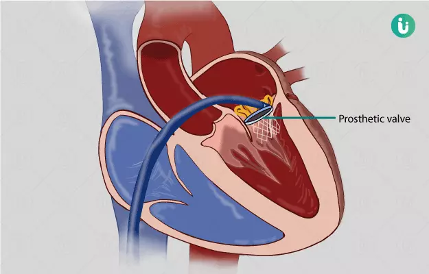 हृदय वाल्व रिप्लेसमेंट सर्जरी - Heart Valve Replacement in Hindi