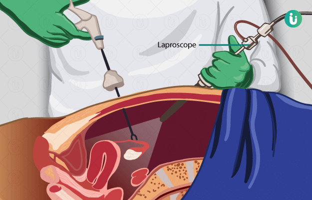Craniotomy for cerebral shunt: MedlinePlus Medical Encyclopedia Image