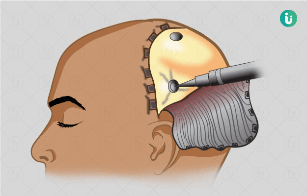 Burr Hole Surgery Procedure Purpose Results Cost Price   Burr Hole Surgery In Hindi 