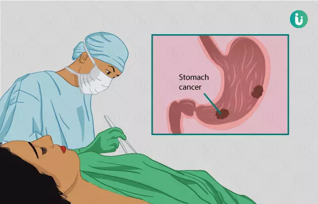 पेट के कैंसर का ऑपरेशन - Stomach Cancer Surgery in Hindi