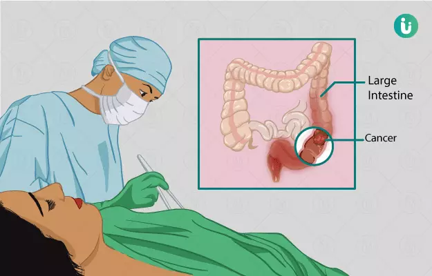 कोलोरेक्टल कैंसर का ऑपरेशन - Colorectal Cancer Surgery in Hindi