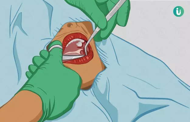 मुंह के कैंसर का ऑपरेशन - Oral Cancer Surgery in hindi