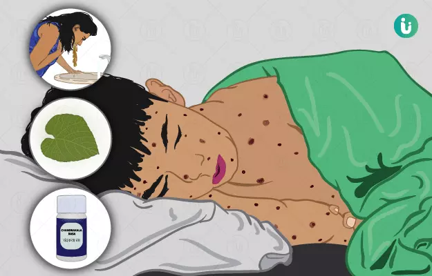 Ayurvedic medicine, treatment and remedies for Chicken Pox