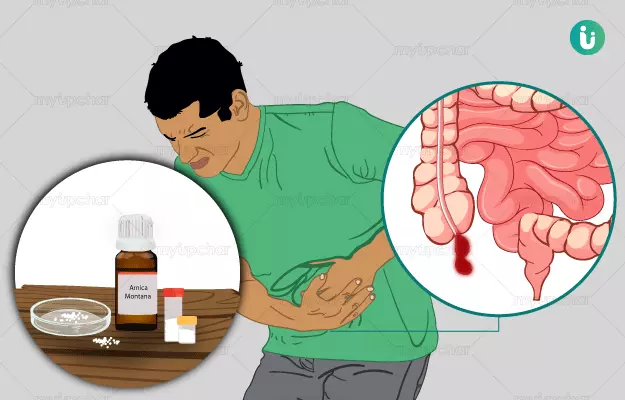 Homeopathic medicine, treatment and remedies for Appendicitis