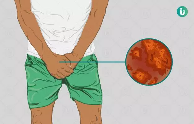 Natural remedies for jock itch