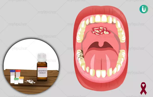 Homeopathic medicine, treatment and remedies for Oral Cancer