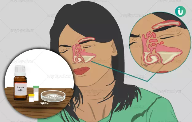 Homeopathic medicine, treatment and remedies for Sinusitis