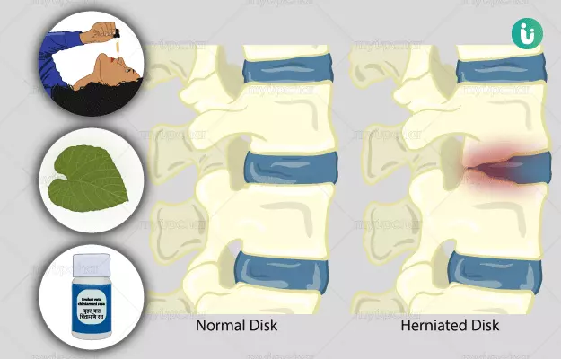 Ayurvedic medicine, treatment and remedies for Slipped Disc