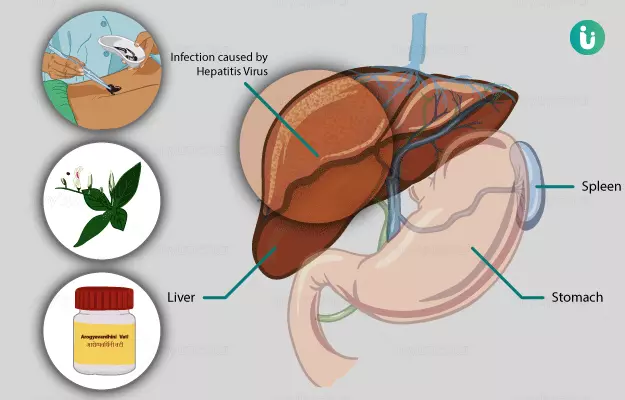 Ayurvedic medicine, treatment and remedies for Hepatitis 
