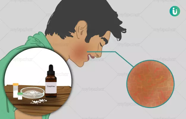Homeopathic medicine, treatment and remedies for Eczema