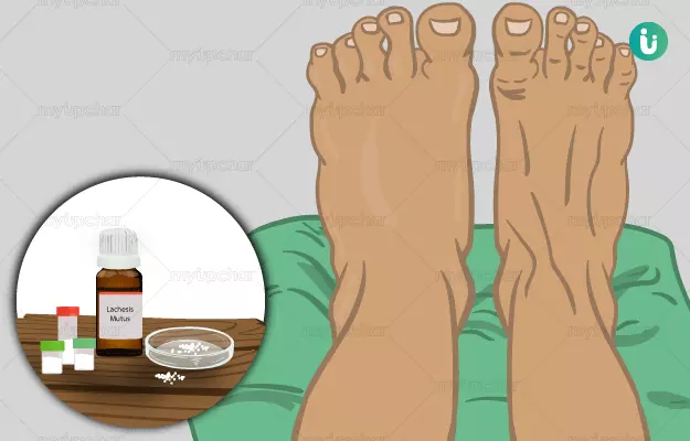 पैरों में सूजन की होम्योपैथिक दवा और इलाज - Homeopathic medicine and treatment for Swelling in Feet in Hindi