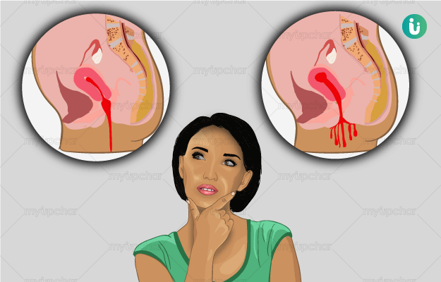 Implantation bleeding: color, timing, symptoms, implantation